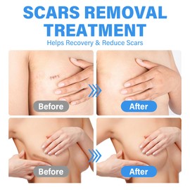 Silicone Scar Sheets,Reusable Silicone Scar Tape Strips - Reusable Strips for C-Section, Surgery, Keloids, 4 Pair