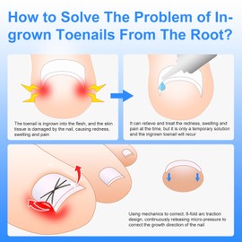 5 Pads Titanium Alloy Ingrown Toenail Treatment, Ingrown Toenail Correctors are Designed to Correct Ingrown Toenails and Restore a Healthy Nail Shape, Ingrown Toenail Removal Kit