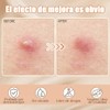 Parches para Acné Estrellas,Estrellas Pimple Patch,Parches Estrellas Acne,Parches Hidrocoloides Absorbentes,