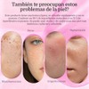 Txa Cream Crema Manchas Faciales Cremas Aclaramiento Piel Oscuras Pecas