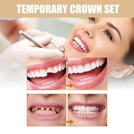 70-Piece Temporary Crown Kit for Teeth Revitalize - Including Prosthetic Front Teeth as Replacement Teeth, False Tooth, and Dental Revitalize Crowns - Ideal for Anterior Teeth Oral Care