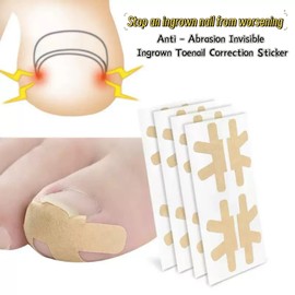 Zanchara Ingrown Toenail Treatment, 20Pcs Breathable Ingrown Toenail Strips,Painless Ingrown Toenail Tool for Nail Removal & Care, At-Home Pedicure Solution (Shape B)