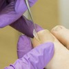 Kosmetex 2 x tamponade for toenails and the nail fold,