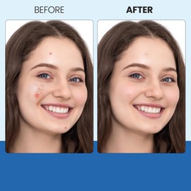 240 Counts Patches for Face, Hydrocolloid Patches Invisible Patches for Skin Care Invisible Concealer for All Skin Type