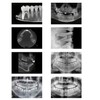 8 Dental X-Rays