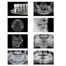 8 Dental X-Rays