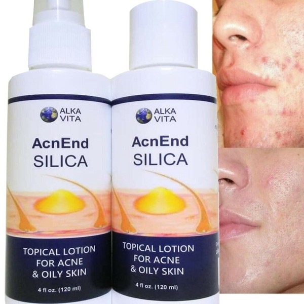Acne Pimples Oily Skin Silica Gel Spray Facial Treatment Fast Results ALKAVITA