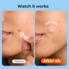TKTK Pimple Patches for Face, 6 Sizes Hydrocolloid Acne Patch
