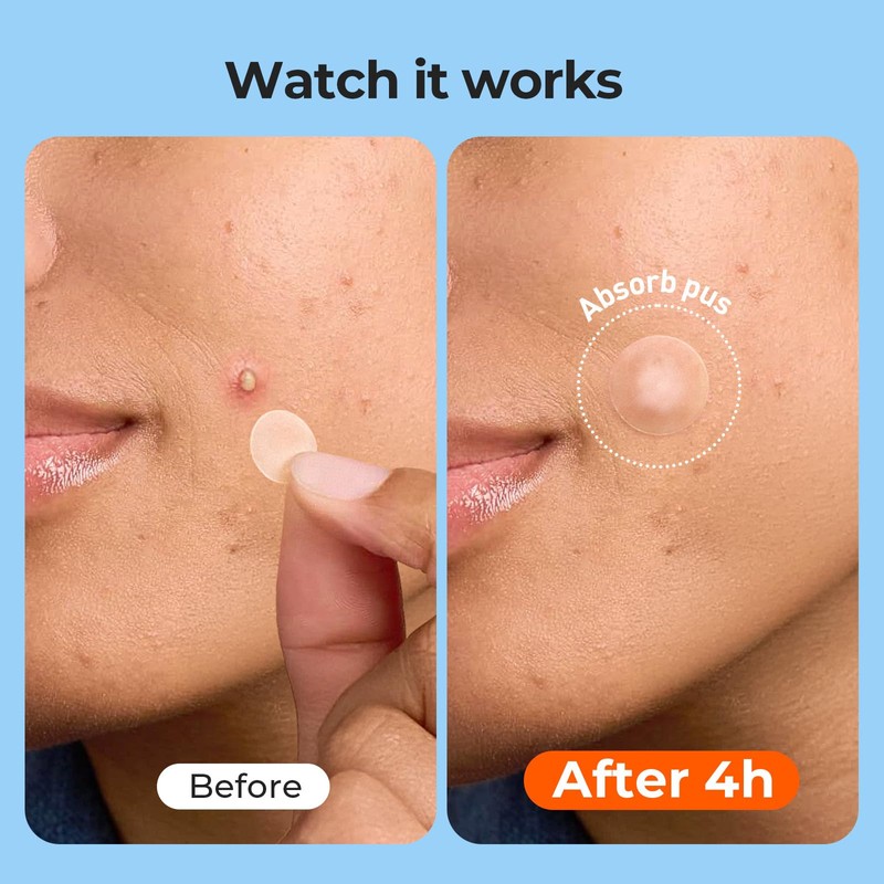 TKTK Pimple Patches for Face, 6 Sizes Hydrocolloid Acne Patch