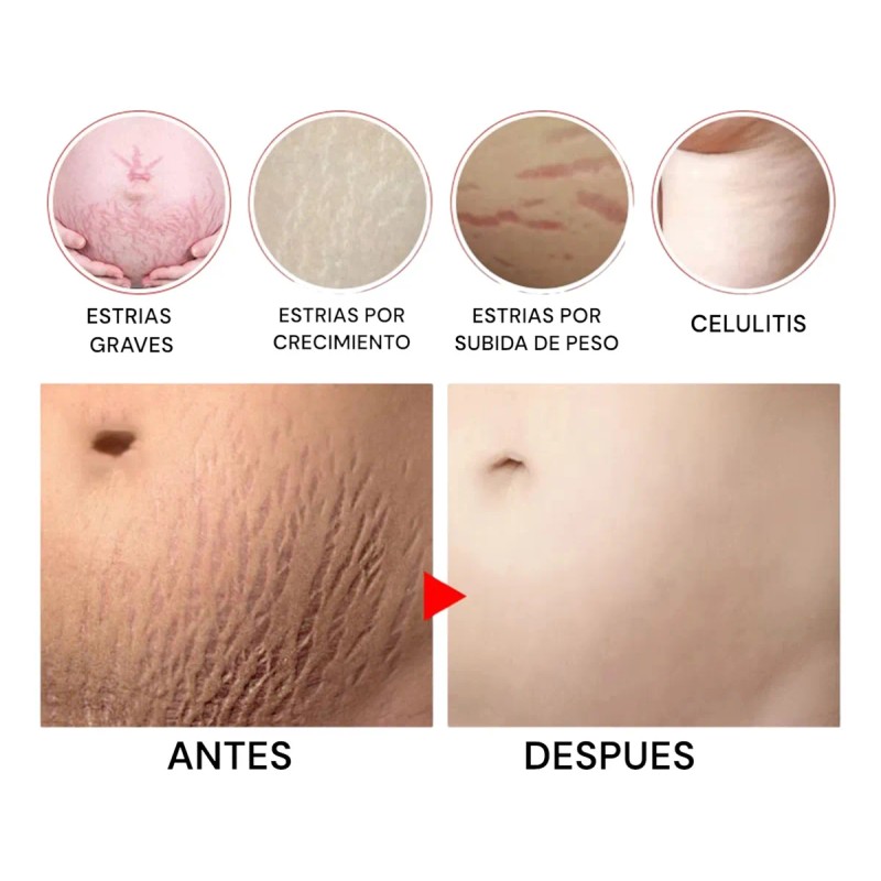 Tratamiento Profesional Permanente Eliminar Estrías Neutra