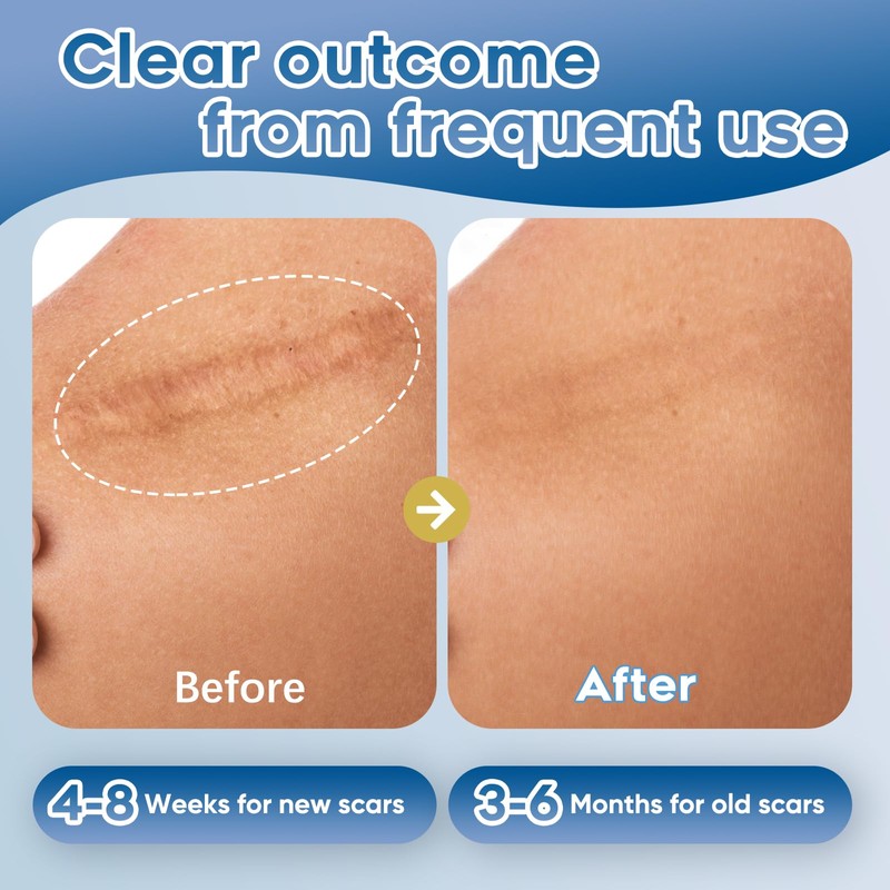 Advanced Silicone Scar Gel for Face & Body – Silicone