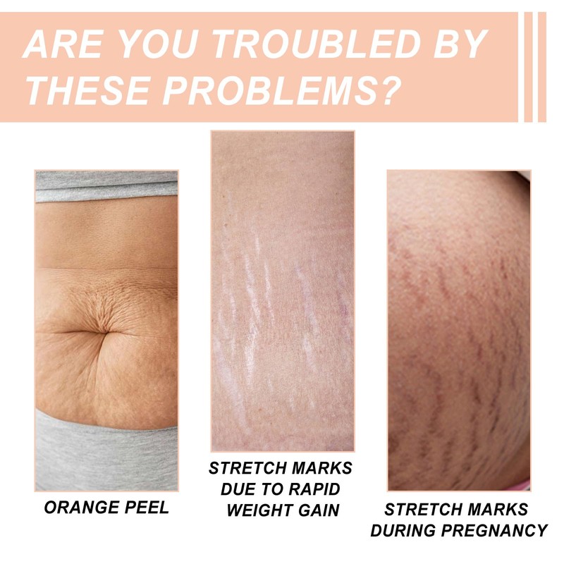 Silicone Patches for Stretch Marks, Anti Wrinkle Stretch Removal Sheet