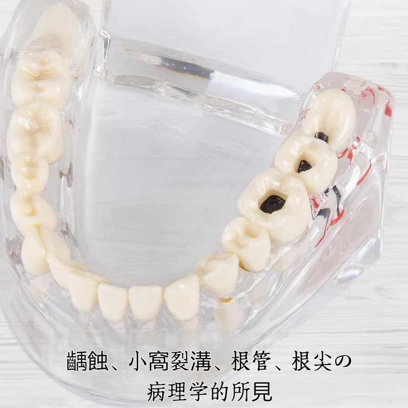 UKYCEORA Transparent Disease Teeth Model, Dental Implant Bridge Dental Teaching