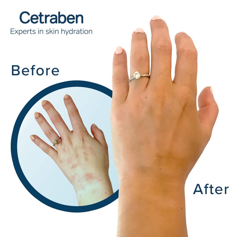 Cetraben Body Lotion Perfect for Dry Sensitive or Eczema Skin