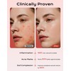 360 Pieces Invisible Pimple Patches, Hydrocolloid Spot Patches, Acne Treatment