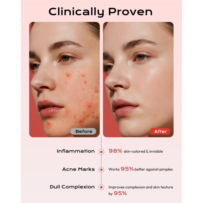 360 Pieces Invisible Pimple Patches, Hydrocolloid Spot Patches, Acne Treatment
