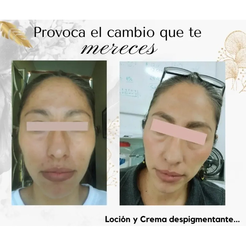 Loción Aclarante Y Quita Manchas Sol Paño Acne Melasma