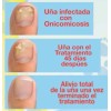 Fungicida Puñas Con Onicomicosis, Hongos, Negras O Amarilla