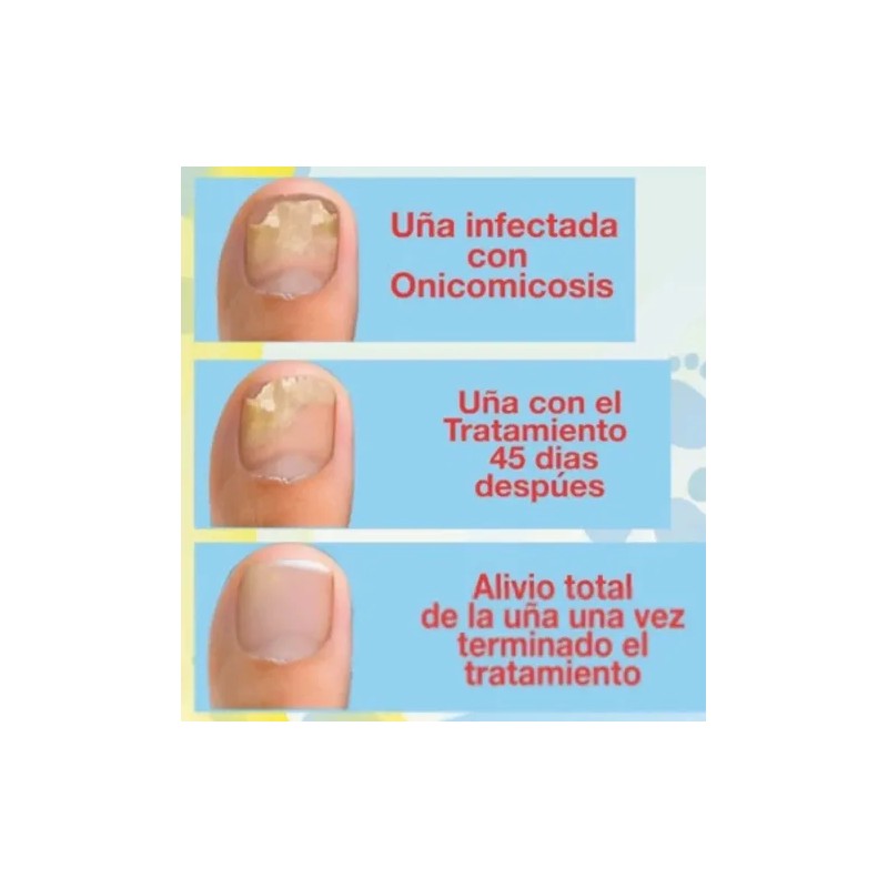 Fungicida Puñas Con Onicomicosis, Hongos, Negras O Amarilla