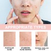 Microdart Pimple Patch - Acne Patches - Spot Patches with
