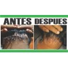 Boxi Tratamiento Para Acné Queloideo De Nuca 120 G