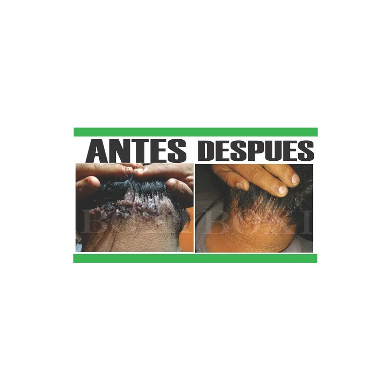 Boxi Tratamiento Para Acné Queloideo De Nuca 120 G