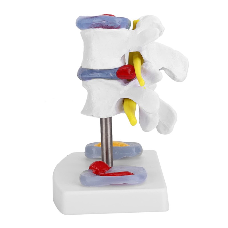 Human Size Medical Model - Anatomical Herniated Disc Demonstration Accessories