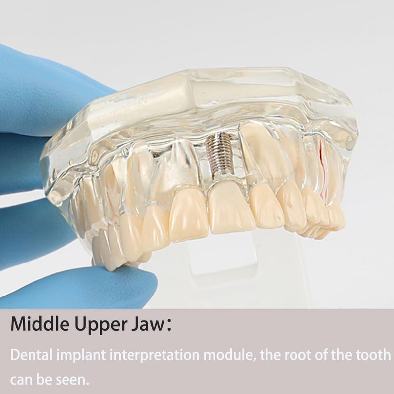 2PCS Transparent Disease Teeth Model, Dental Implant Teeth Model, Dental