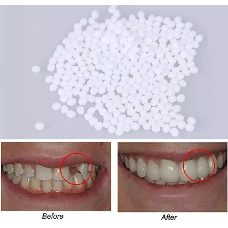 Reparación De Dientes, Sólido,temporal Duradero,reutilizable