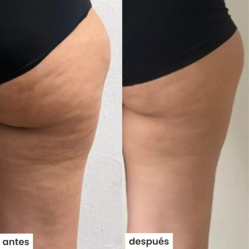 Azala Natura Kit Azala S/ Ventosa- Tratamiento Para Celulitis