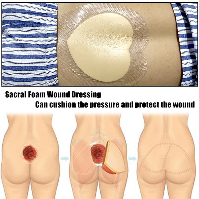 Sacral Foam Wound Dressing - Pressure Adhesive Pad for Elderly