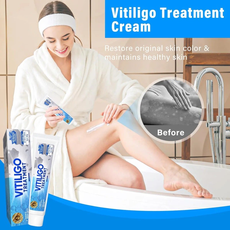 Tratamiento De Vitíligo, Tratamiento Natural De Crema De Vit