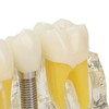Teeth Implant Model Transparent Dental Teaching Research Demonstration Teeth Model