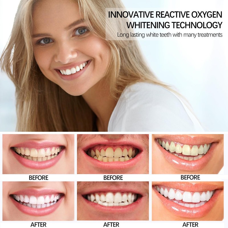 SSKHE Pack of 28 Teeth Whitening Bands, 9D Teeth Whitening