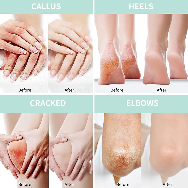 Urea Cream 50 Percent for Feet with Coconut 5.29 oz