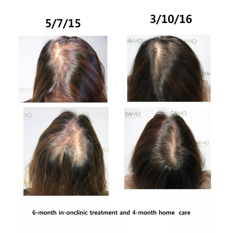 DAMO hair loss control shampoo