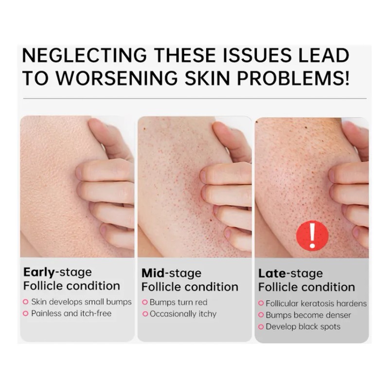 Crema Blanqueadora Para Tratar La Queratosis Corporal Con Pr