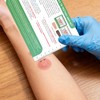 Ultrassist Tuberculosis(TB) Test Palpable Arm Set - Realistic Dual-Tone Training