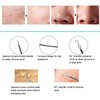 Blackhead Removal Rechargeable 5 Adjustable Suction Electric Pore Acne Cleaner