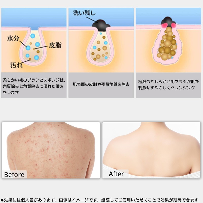 Body Brush, Foldable, Back Acne Treatment, Gentle Keratolytic Care, Back
