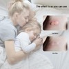 Mosquito Bite Antipruritic Instrument Adjustable Anti Mosquito Antipruritic Pen