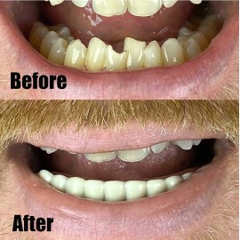 Billy Bob Bottom Teeth Flexible Lower Veneer False Cosmetic secure smile Instant Smile