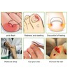 10pcs Toenail Correction Strips Brace Elastic Change Growth Direction Ingrown