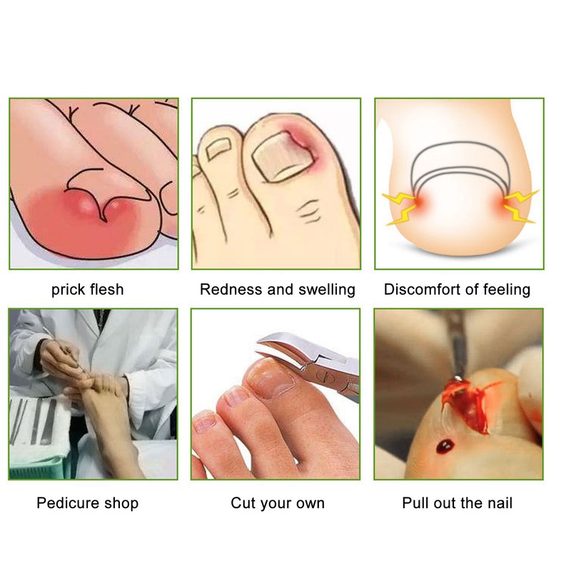 10pcs Toenail Correction Strips Brace Elastic Change Growth Direction Ingrown