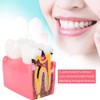 Modelo de encía dental, modelo de estudio comparativo de caries