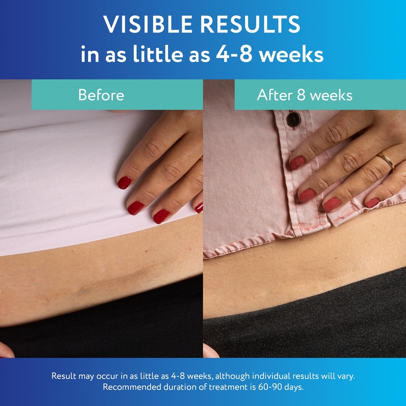 ScarAway Advanced Clear Silicone Scar Sheets, Medical Grade Silicone Strips