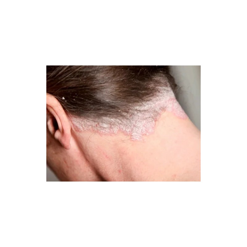 Kit Shampoo Psoriasis Y Caspa Alquitran Hulla 2lt Envío Grat