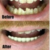 Instant Smile Comfort Fit Flexible Lower Teeth