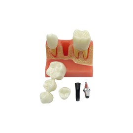 SENLIN DENTAL 4 Times Teeth Implant Models, Dental Model for Patient Education and Class Studying Teeth Model, Dental Implant, Crown and Bridge Model for Presentation