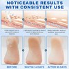 Urea Cream 60 Percent for Feet with 2% Salicylic Acid,